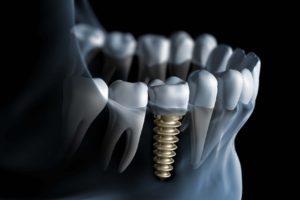 Implanty stomatologiczne, dentystyczne - implanty zębów Warszawa